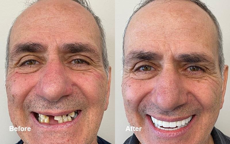 Smile Makeover result — Maria L.
