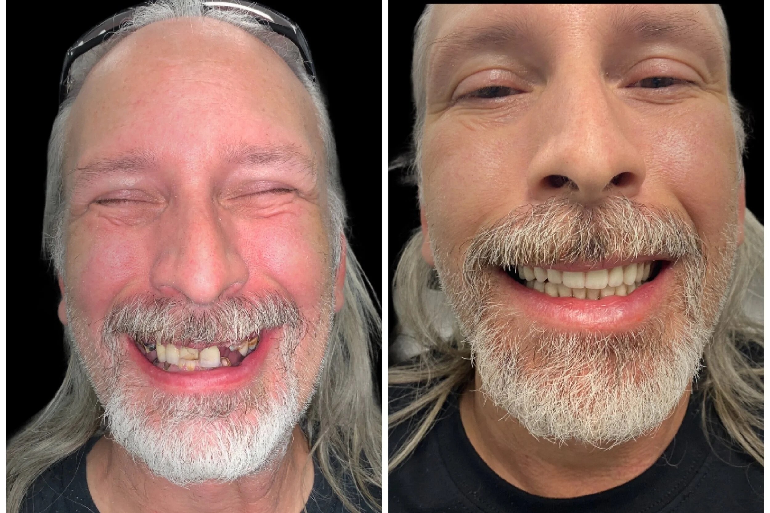 Full Arch Restoration result — Jese A.