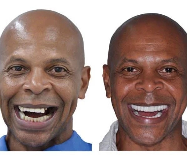 Dental Implant result — Isaac R.